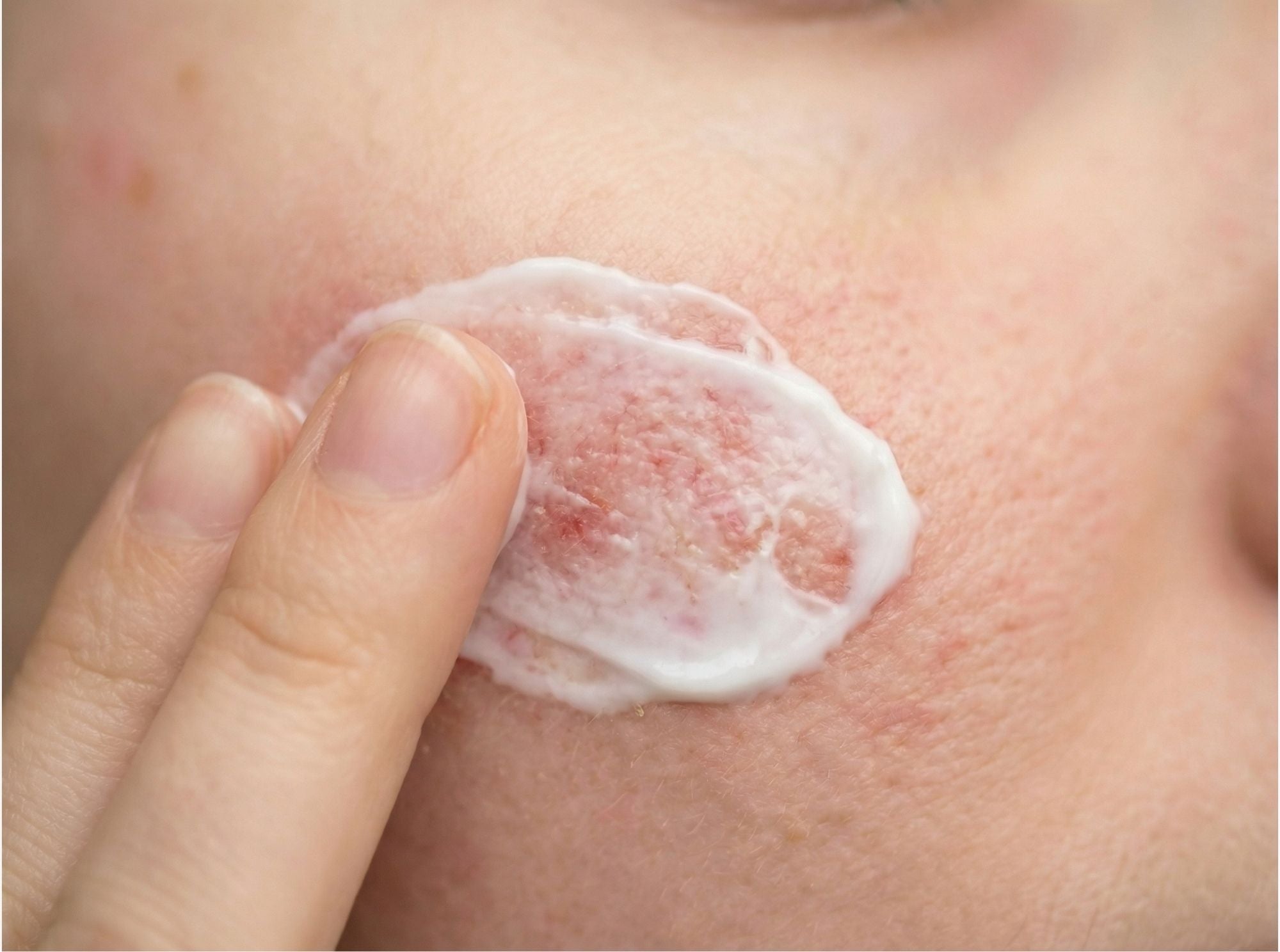 Close-up van huid met roodheid terwijl crème wordt aangebracht ter ondersteuning van huidbalans en comfort