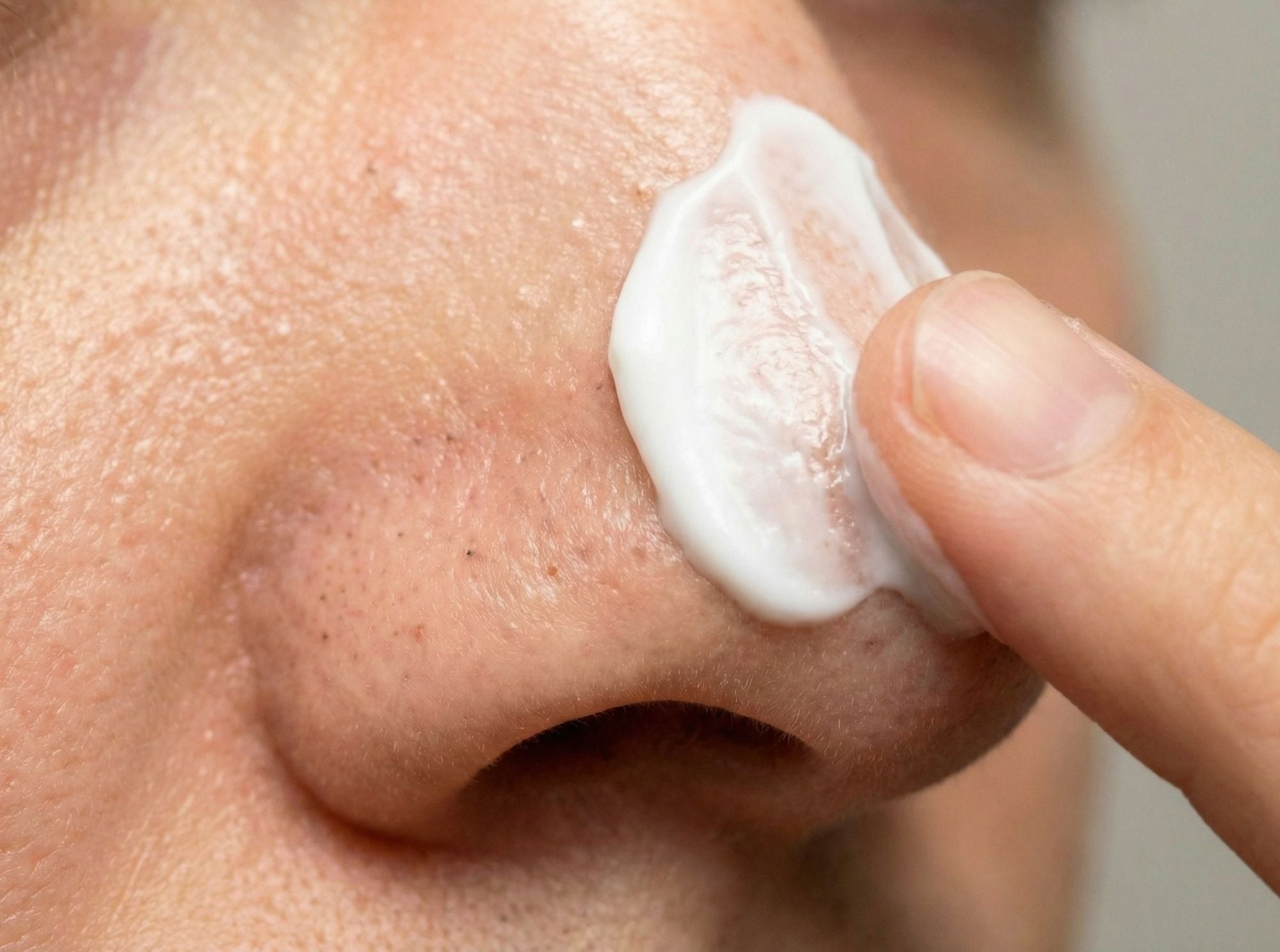 Close-up van neus met crème aangebracht op huid met puistjes en mee-eters ter ondersteuning van een zuiverder uitziende huid