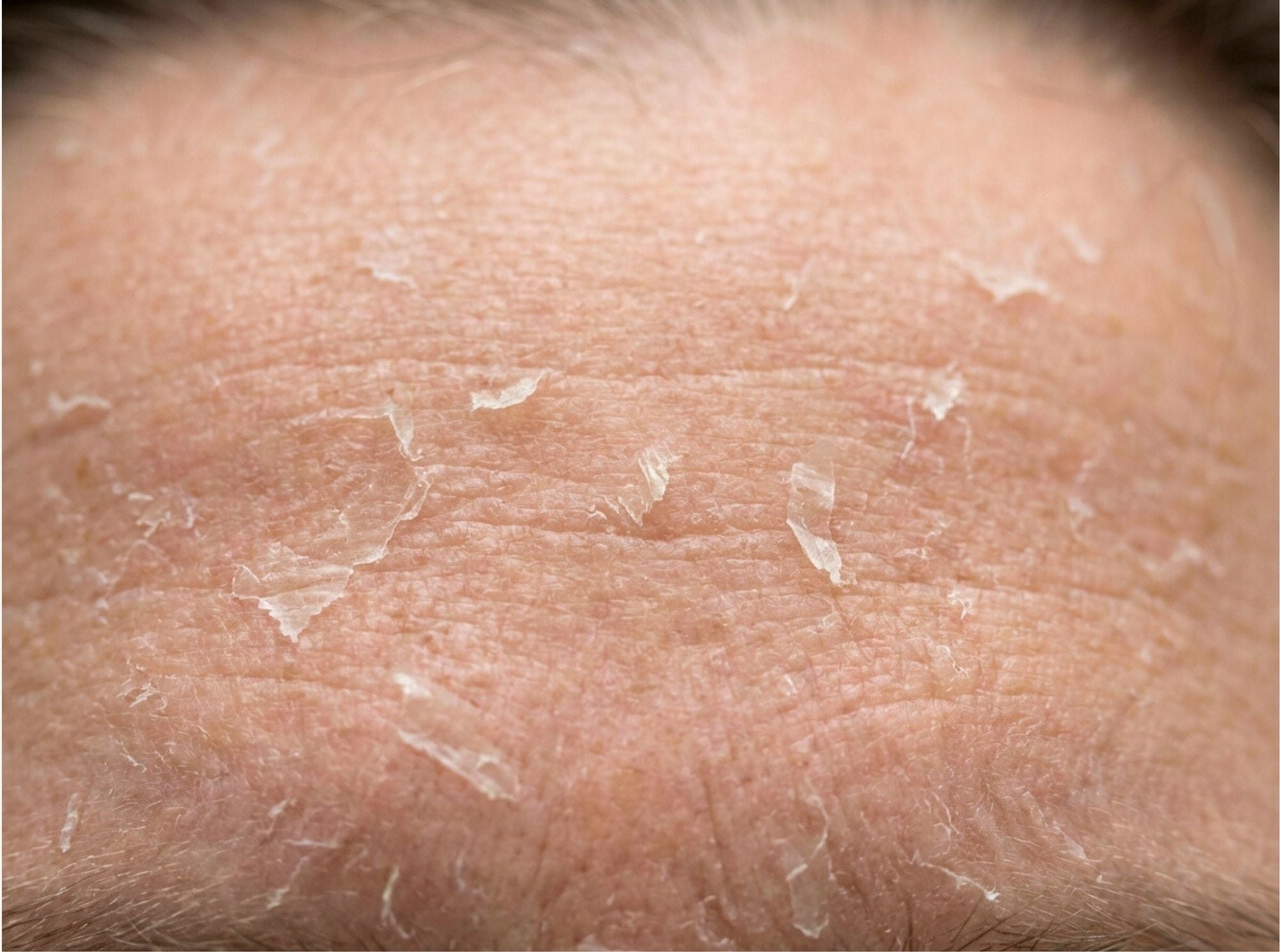 Close-up van droge, schilferige huid die tekenen van uitdroging vertoont waarvoor een skin conditioner ondersteuning biedt