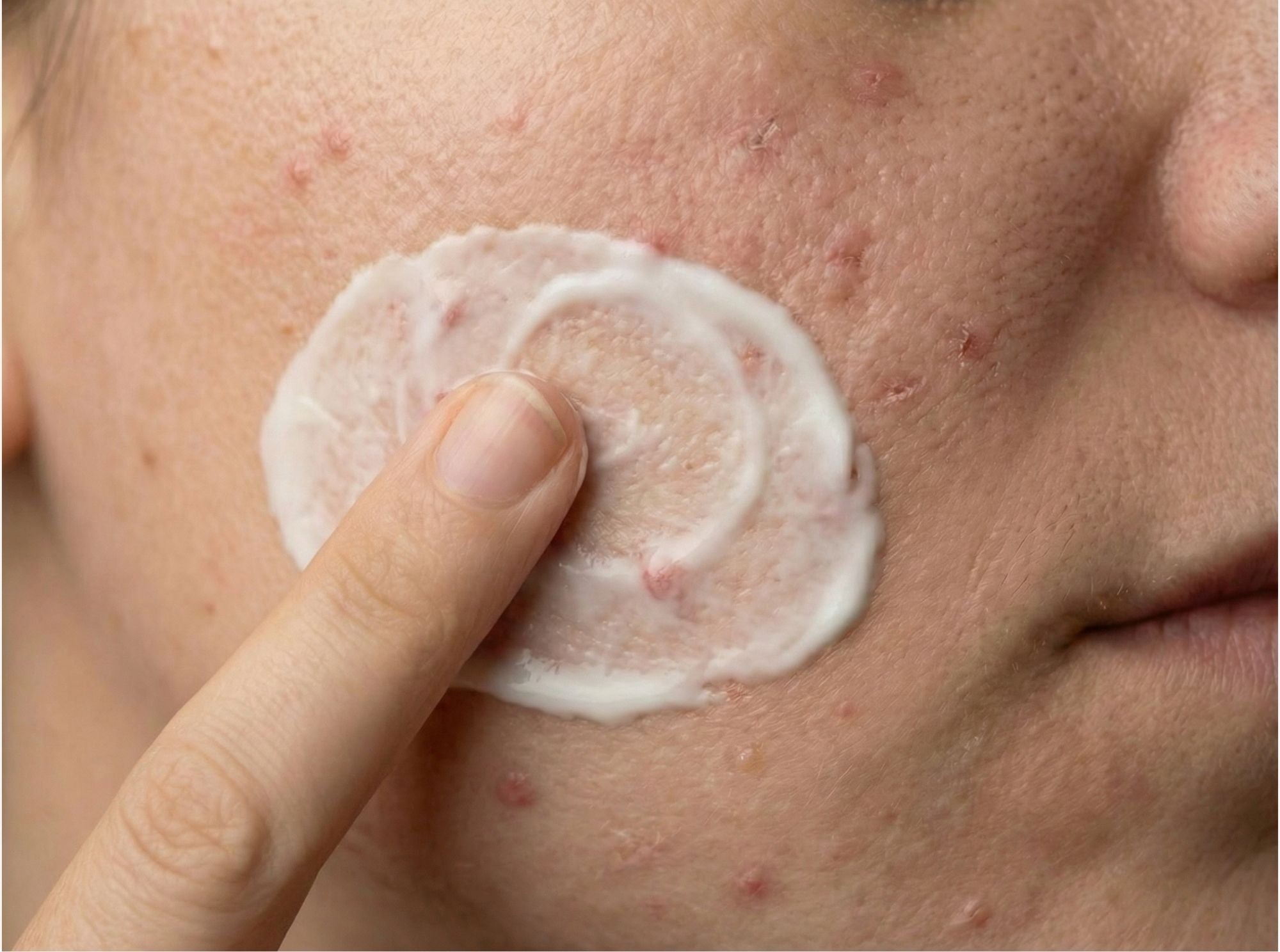 Close-up van huid met onzuiverheden waarop crème wordt aangebracht ter ondersteuning van een egalere huid