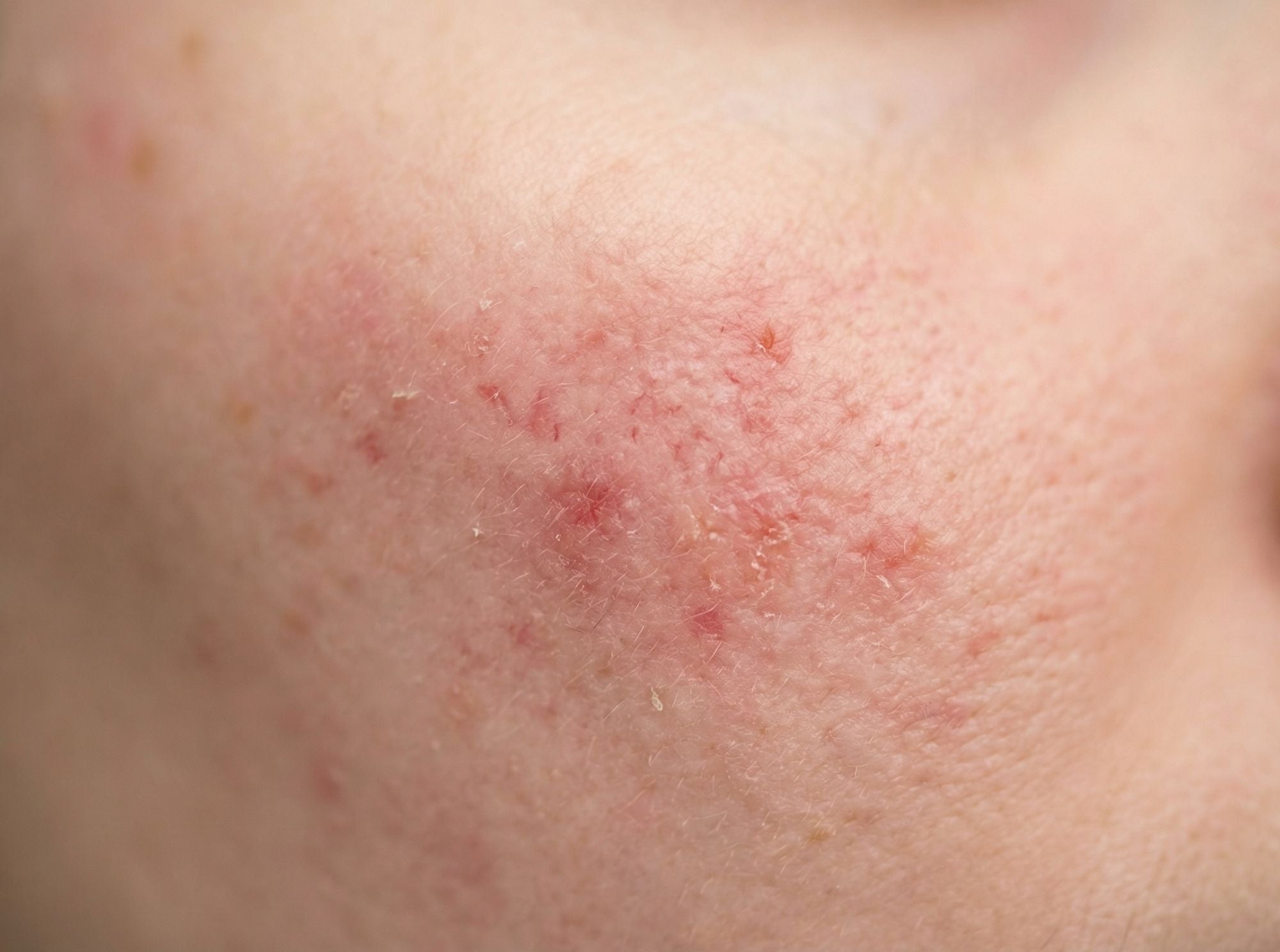 Close-up van huid met roodheid en irritatie als veelvoorkomend huidprobleem waarbij een skin conditioner kan ondersteunen