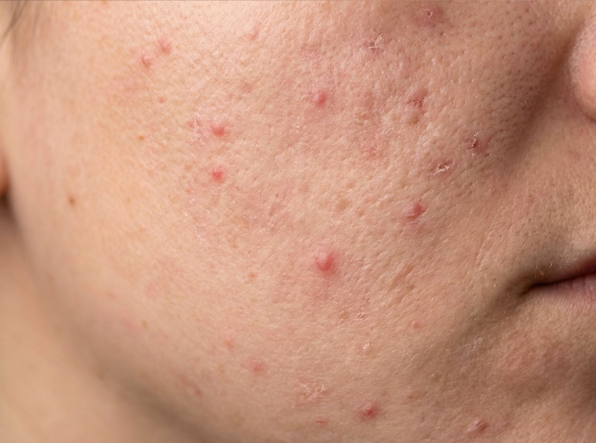 Close-up van huid met onzuiverheden en oneffen textuur als huidprobleem waarbij een skin conditioner ondersteuning biedt