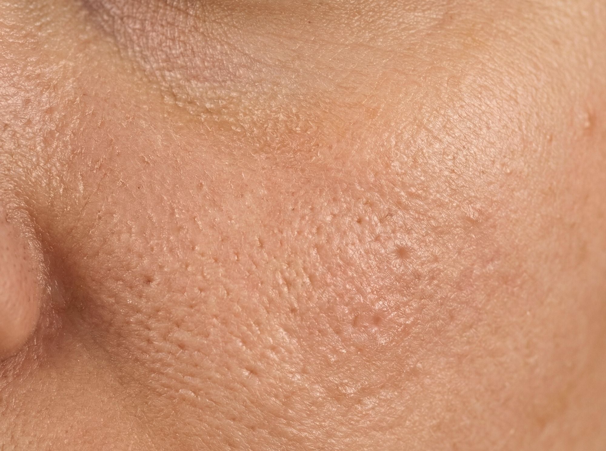 Skin conditioner voor grote poriën