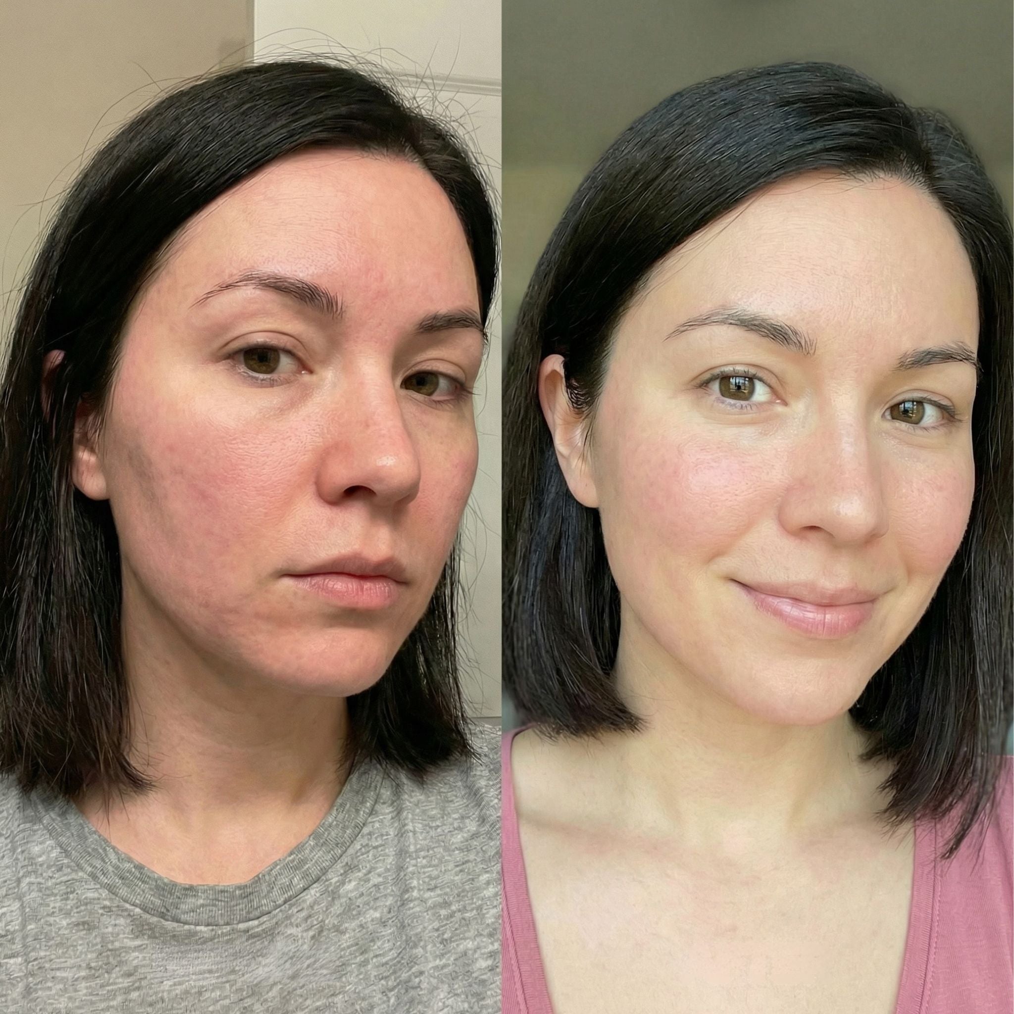 Voor en na vergelijking die een verbeterde huidconditie toont na gebruik van Q-Viva Skin Conditioner